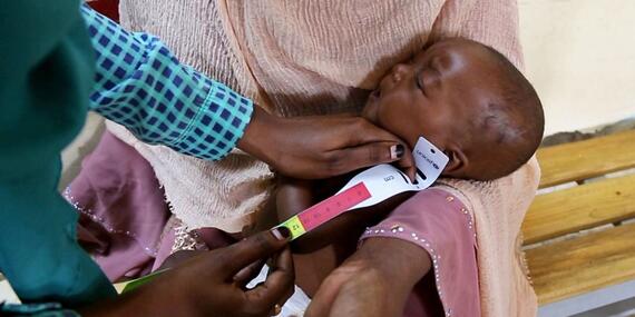 A six-month-old baby is screened for malnutrition during a visit to the hospital in Blue Nile state, Sudan.