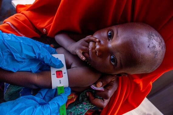 A young baby undergoing a malnutrition check